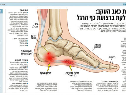 מה זה דורבן בעקב: איך לזהות בזמן ולטפל בכאב ביעילות